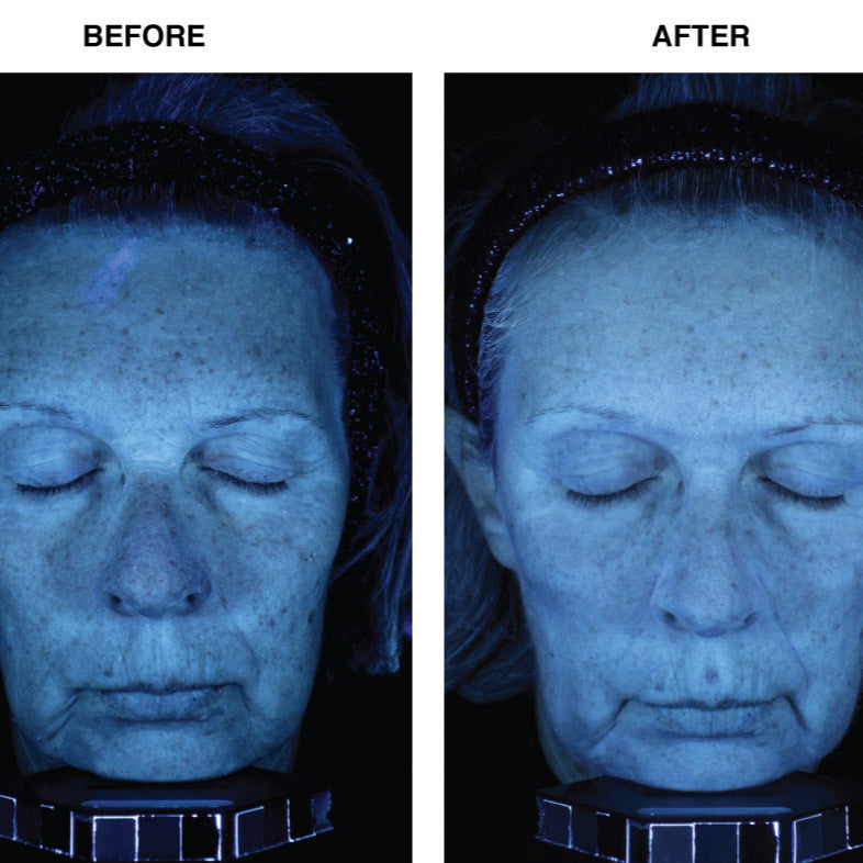 Before and after comparison of a person's face under ultraviolet light.